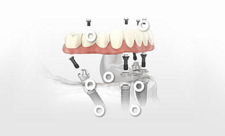 $3,999 for a One Premium Titanium Dental Implant incl. Ultra Premium Abutment & Crown - Options for up to Five Implants