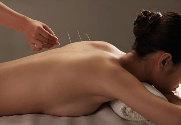 One-Hour Acupuncture Session - Option for Three Sessions
