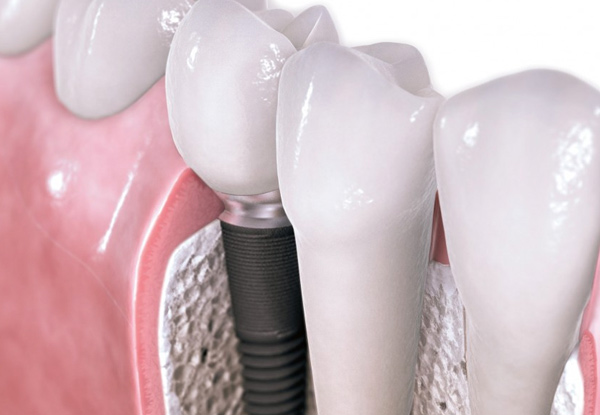 One Premium Titanium Dental Implant incl. an Ultra Premium Abutment & Crown - Options for up to Five Implants