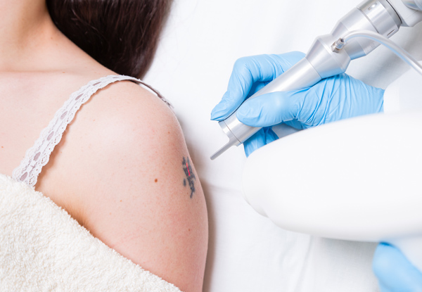 $69 for One Tattoo Removal or Fade Treatment for an Area up to 15 x 15cm (value up to $100)
