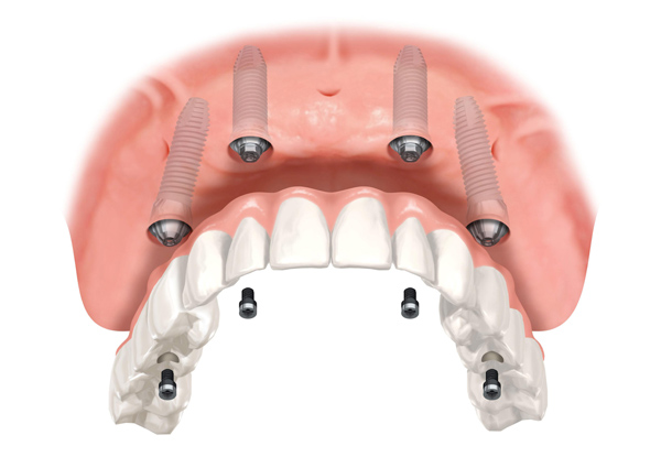 $1,549 for a Premium Dental Implant or $1,949 to incl. a Travel Voucher to Auckland (value up to $19,500)