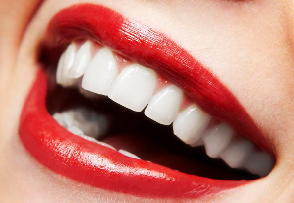Professional Teeth Whitening Package incl. Consultation, One-Hour Teeth Whitening & $50 Return Voucher - Rotorua