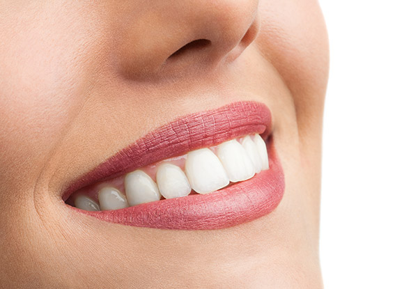 $129 for a Teeth Whitening Treatment incl. a Take Home Whitening Product (value up to $428)