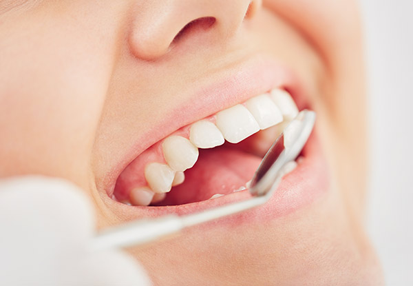$99 for a Comprehensive Dental Exam, Two X-Rays, Clean, Scale & Polish (value up to $184)