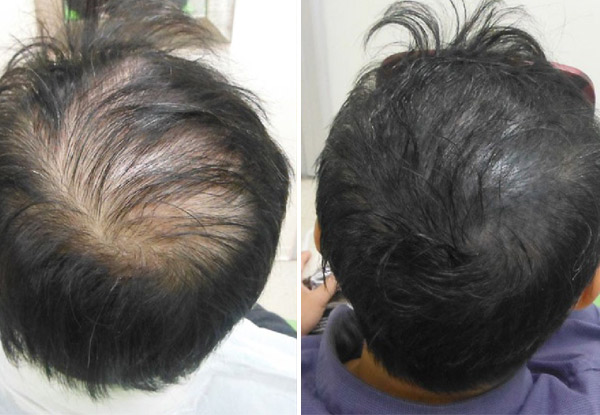 From $800 for a Complete Scalp Micropigmentation (SMP) Course Incl. Three Sessions – Options Incl. Scar Camouflage, Hair Density & Full SMP (value up to $3,000)