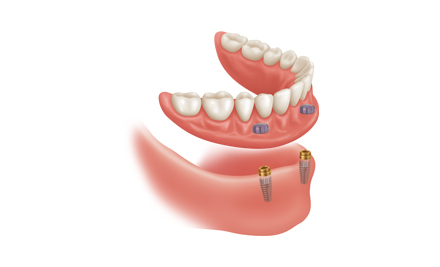 $3,999 for a One Premium Titanium Dental Implant incl. Ultra Premium Abutment & Crown - Options for up to Five Implants