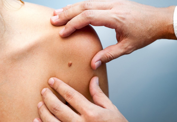 $99 for a Full Body Skin Cancer & Melanoma Check incl. Mole Mapping using Foto Finder (value up to $99)