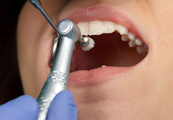 $89 for a One-Hour Professional Dental Clean & $50 Voucher – Four Wellington Locations (value up to $205)