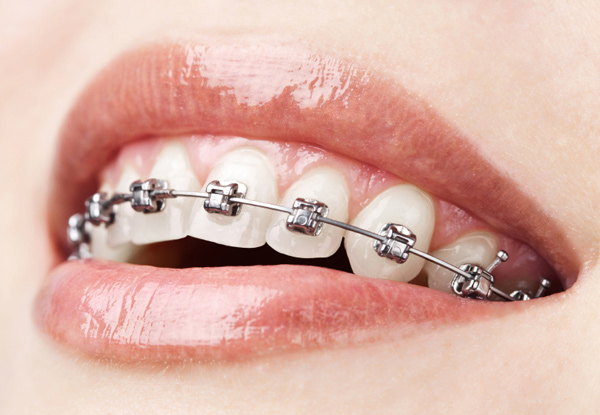 $999 for a Braces Deposit incl. Consultation, Panoramic & Cephlometric X-Ray