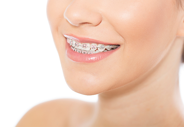 $99 for a $2,000 Voucher Towards Braces