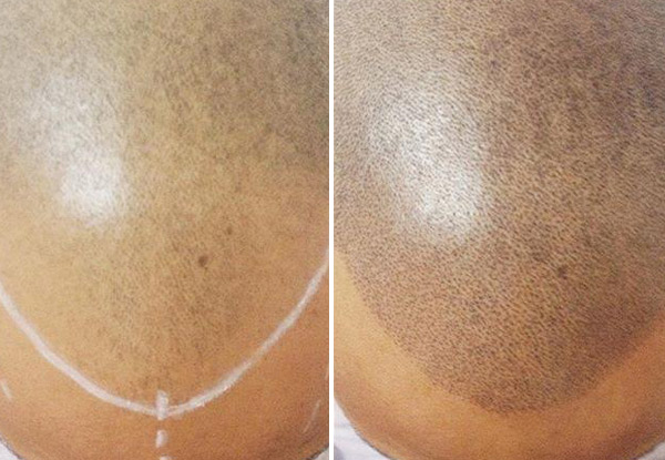 From $800 for a Complete Scalp Micropigmentation (SMP) Course Incl. Three Sessions – Options Incl. Scar Camouflage, Hair Density & Full SMP (value up to $3,000)