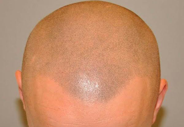 From $800 for a Complete Scalp Micropigmentation (SMP) Course Incl. Three Sessions – Options Incl. Scar Camouflage, Hair Density & Full SMP (value up to $3,000)