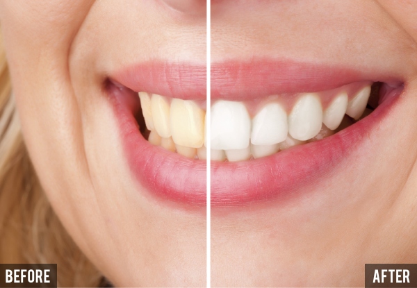 75-Minute Certified Teeth Whitening incl. Consult & Aftercare - Option for 90-Minute Medium or Heavy Treatment
