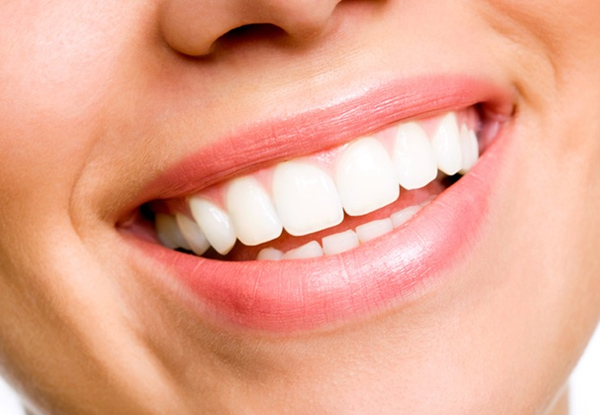$79 for a Professional Teeth Whitening Treatment (value up to $270)