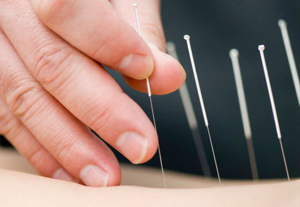 One-Hour Acupuncture Session - Option for Three Sessions