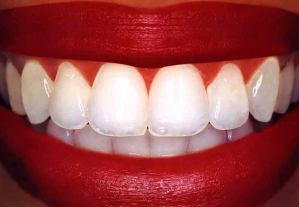 $99 for a $2,000 Voucher Towards Ceramic Braces, incl. Complimentary Orthodontic Assessment
