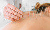 60-Minute Acupuncture Treatment