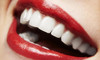 Certified Teeth Whitening Package