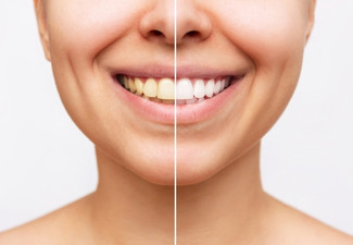 45-Minute Teeth Whitening Session