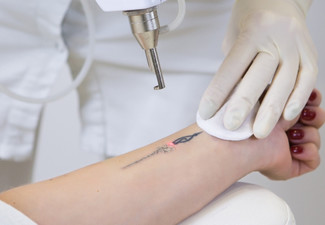 Tattoo Removal Auckland  Beautilase