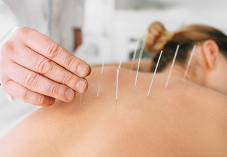 One Hour Acupuncture Session for One Person - Option to incl. 20-Minute Cupping
