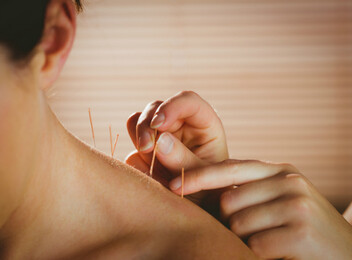 60-Minute Acupuncture Session