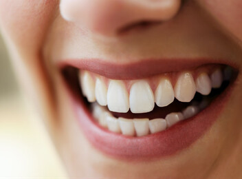 Laser Teeth Whitening Treatment