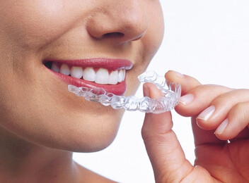 Deposit for an Invisalign® Package