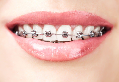 Metal Braces Teeth Straightening Package - Option to Purchase Deposit & Payment Plan