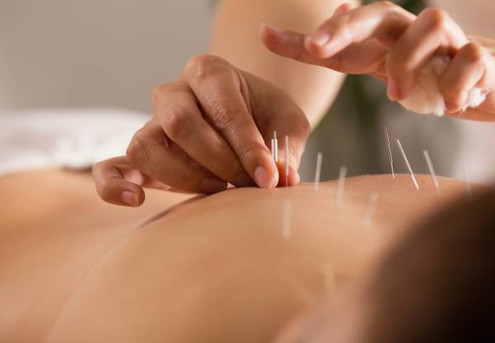 60-Minute Acupuncture Treatment incl. Therapeutic Massage - Options for up to Three Sessions Available - Valid at Rosedale Clinic Only