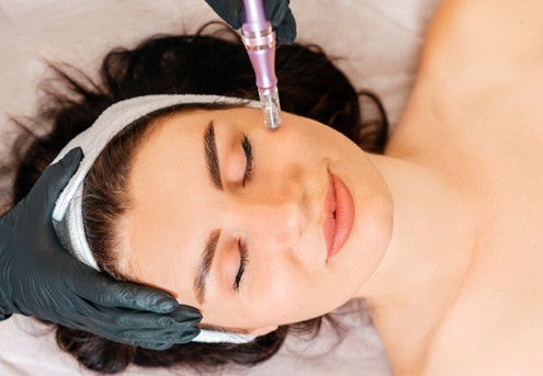 One Facial Micro Needling Session for One - Option for Five Sessions incl. Take Home Aftercare Pack