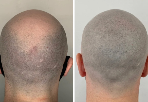 Scalp Micropigmentation Treatment - Option for Partial Blending or Full Head incl. Consultation, One Session & One Follow-Up Session