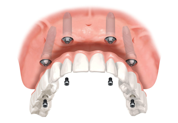 Premium Dental Implant Ideal for All On 4-6 Cases
