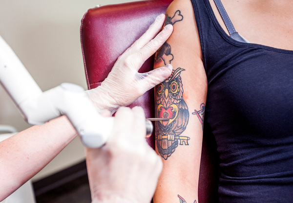 Three Tattoo-Removal Sessions - Options for up to Twelve Square Inches