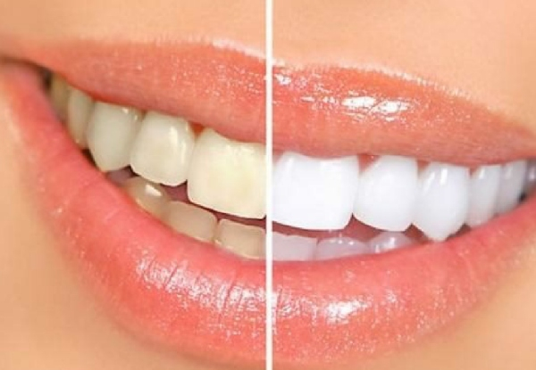 Teeth Whitening Treatment - Four Packages Available
