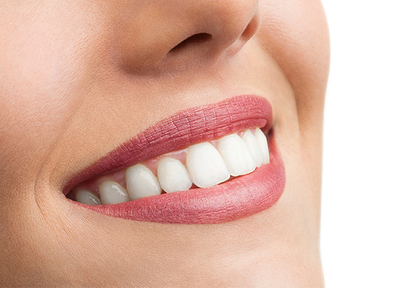 From $999 for Two Porcelain Veneers with an Exam & X-Rays – Options for up to Eight Porcelain Veneers