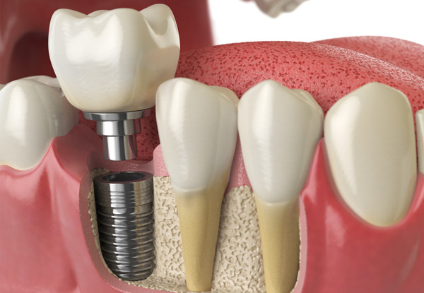 Deposit for One Premium Biohorizons® Dental Implant including Dental Consultation & Procedure with Abutment and Crown - Option for Full Prepayment