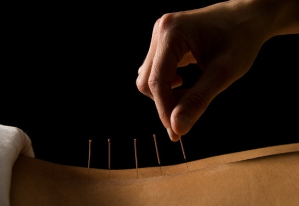 One Session of Acupuncture Treatment at BAHC Acupuncuture - Option for Three Sessions