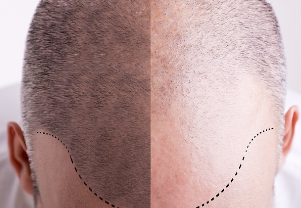 Scalp Micropigmentation for Men – Option for Half-Head & Full Head