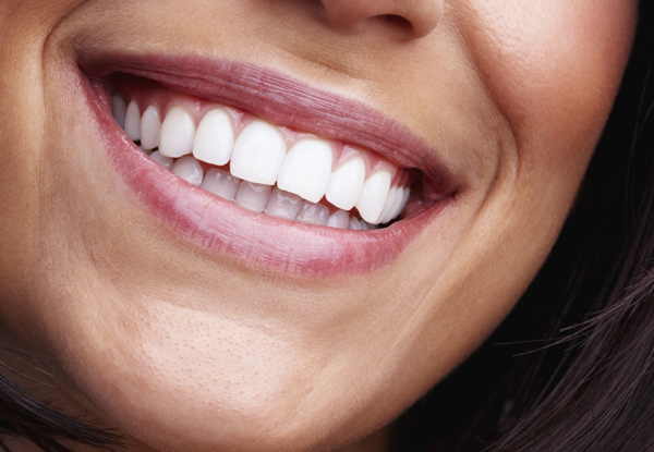 60-Minute Boost Teeth Whitening Treatment incl. Consult & $50 Return Voucher - Nelson