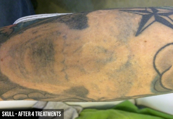 Three Laser Tattoo Removal Sessions