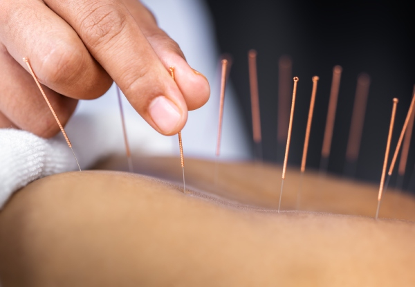 One-Hour Acupuncture Treatment - Option for ACC or Private Treatment
