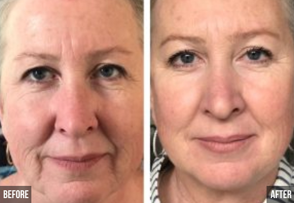Non-Surgical Face Lifting Treatment - Options for One, Two or Three Sessions