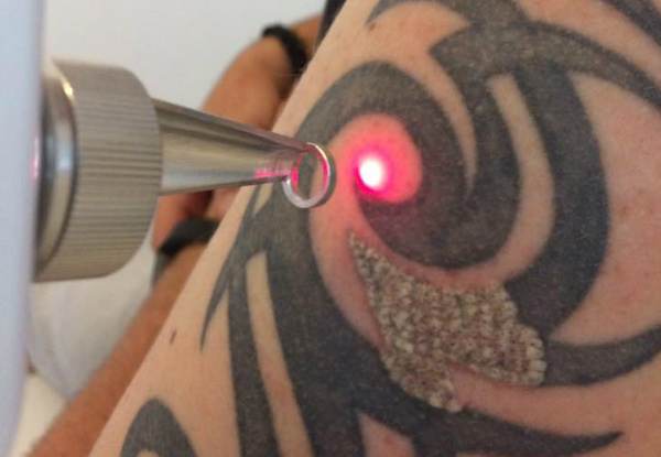Laser Tattoo Removal Session - Option for Three Sessions