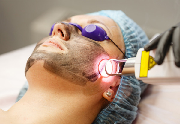 One-Hour Carbon Laser Facial - Options for Up to Three Facials