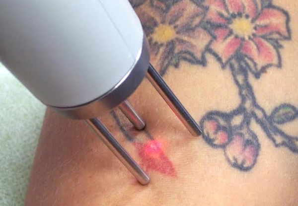 Tattoo Removal Session - Options for Different Size Tattoos