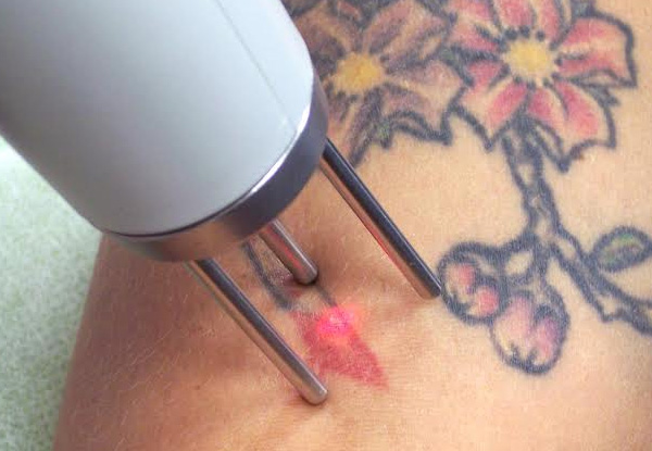 Two Tattoo Removal Sessions - Options for Different Size Tattoos