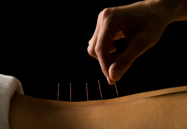 Wellbeing 60-Minute Acupuncture Session - Valid Monday to Friday