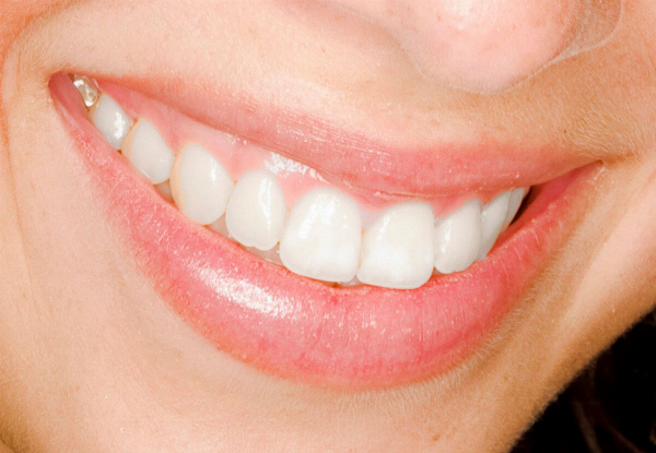 One Ultra Sonic Vibration Teeth Whitening Session incl. Consultation