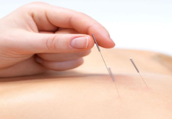 45-Minute Acupuncture for One Person - Option for Acupuncture & Cupping, Acupuncture & Massage or Any Three Sessions